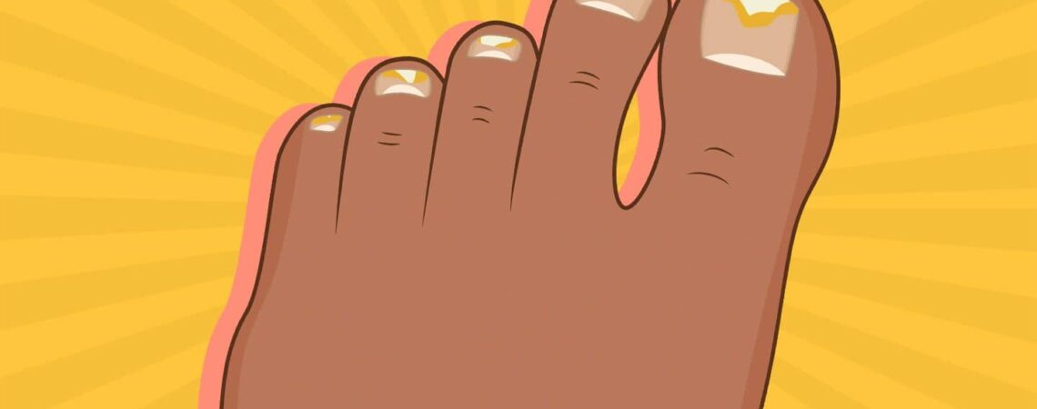 Tips for Keeping Foot Fungus at Bay